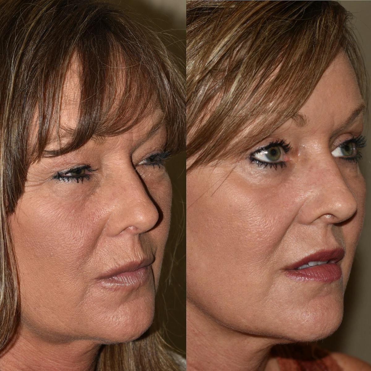 Brow Lift Before & After Gallery - Patient 713385 - Image 2