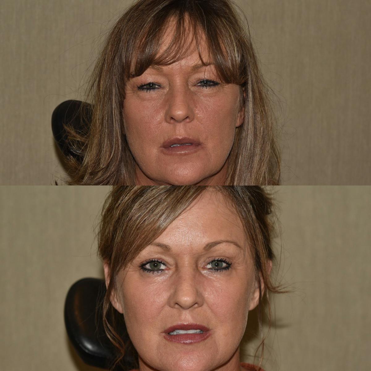Brow Lift Before & After Gallery - Patient 713385 - Image 3