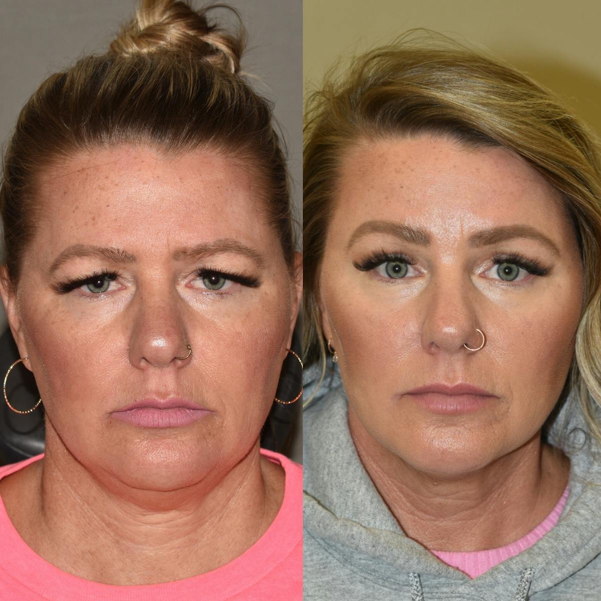 Brow Lift Before & After Gallery - Patient 111175 - Image 1