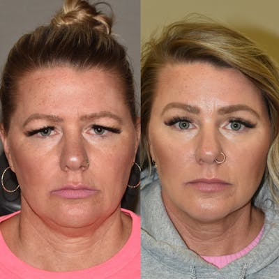 Brow Lift Before & After Gallery - Patient 111175 - Image 1