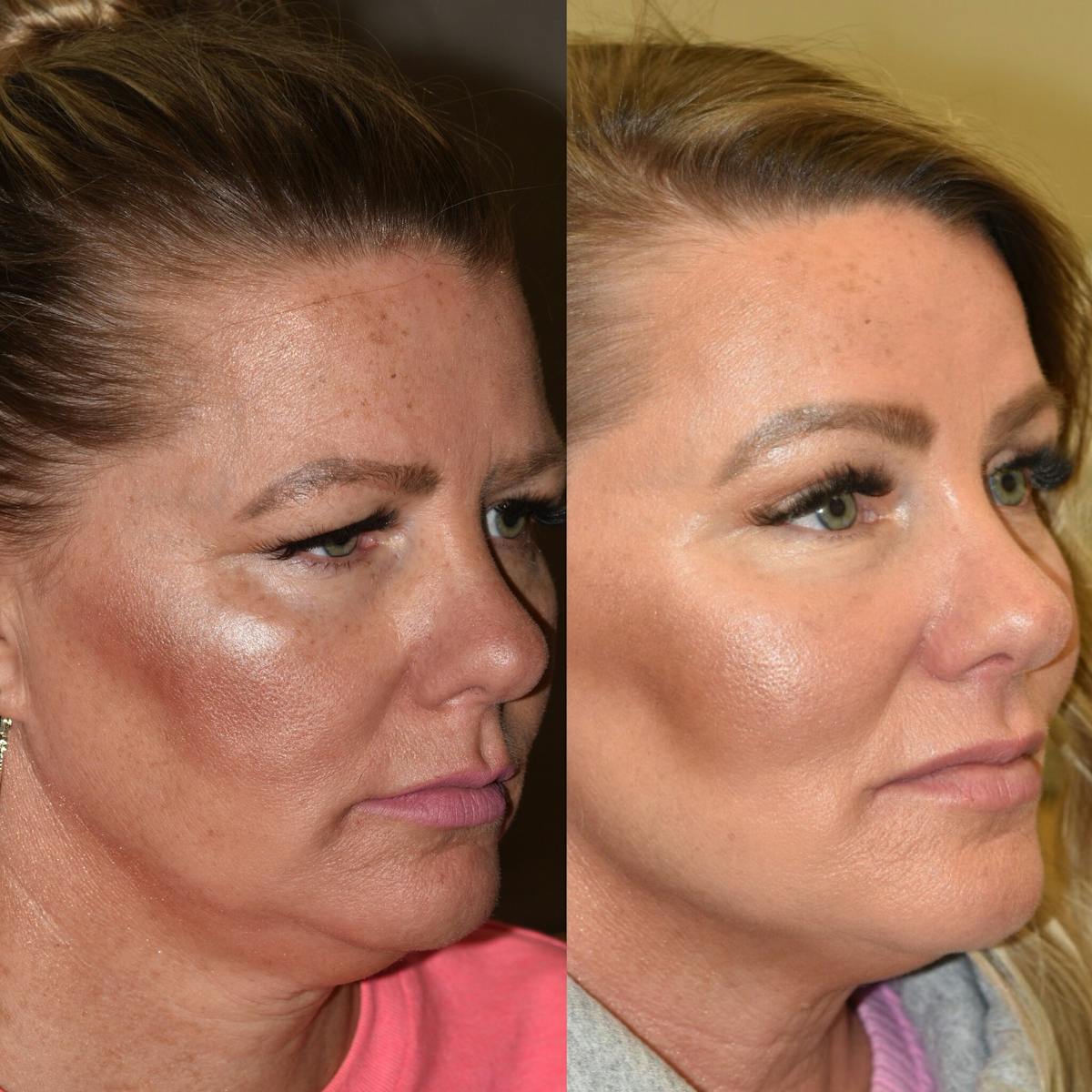 Brow Lift Before & After Gallery - Patient 111175 - Image 2
