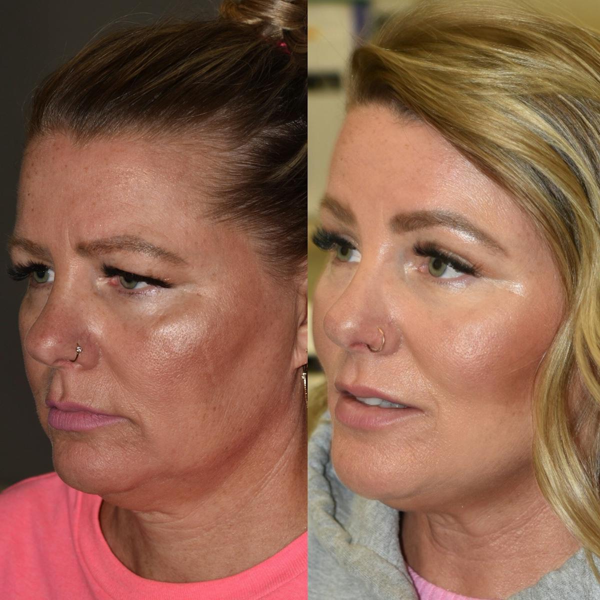 Brow Lift Before & After Gallery - Patient 111175 - Image 3