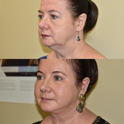 Neck Lift Before & After Gallery - Patient 207892 - Image 1