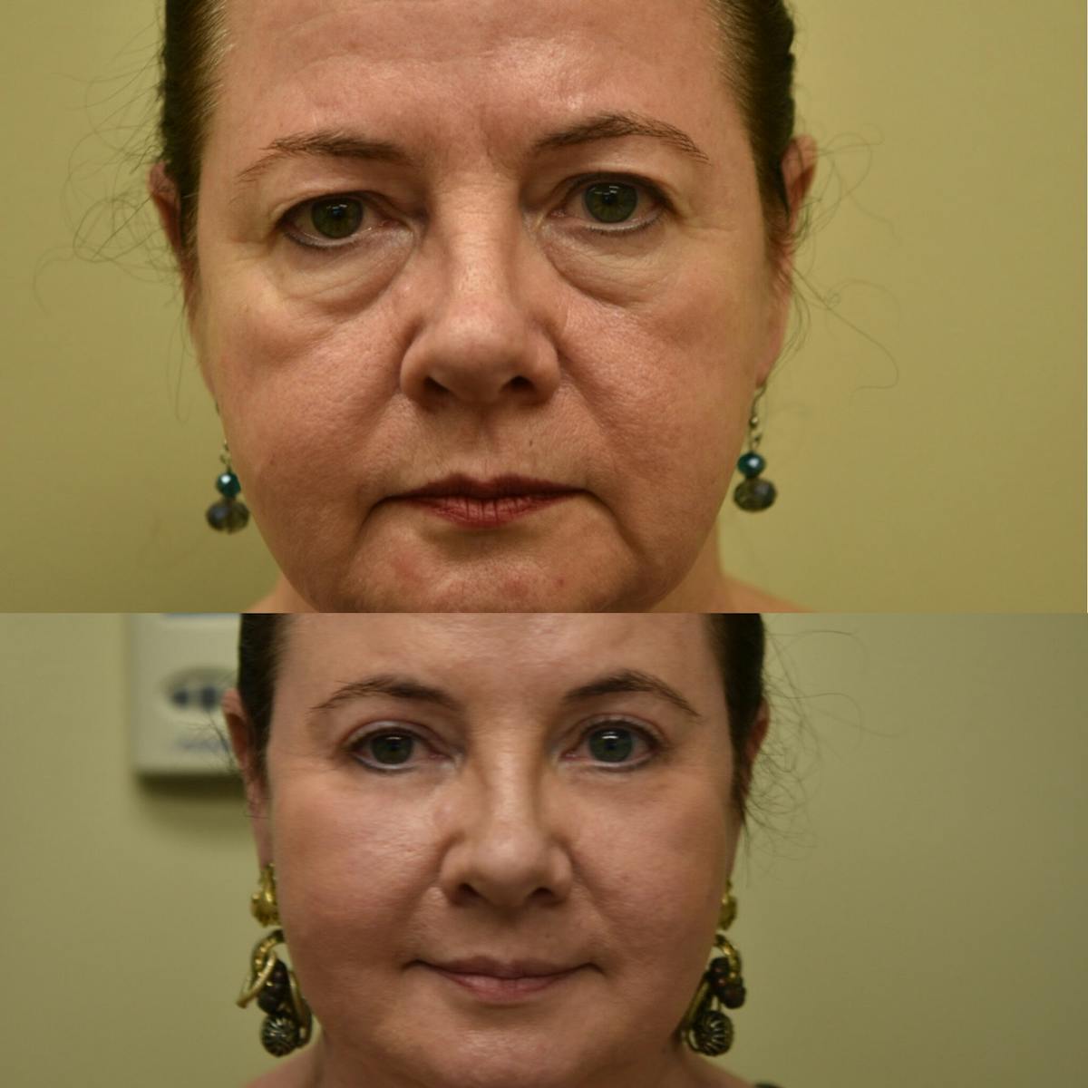 Eyelid Surgery Before & After Gallery - Patient 283826 - Image 2