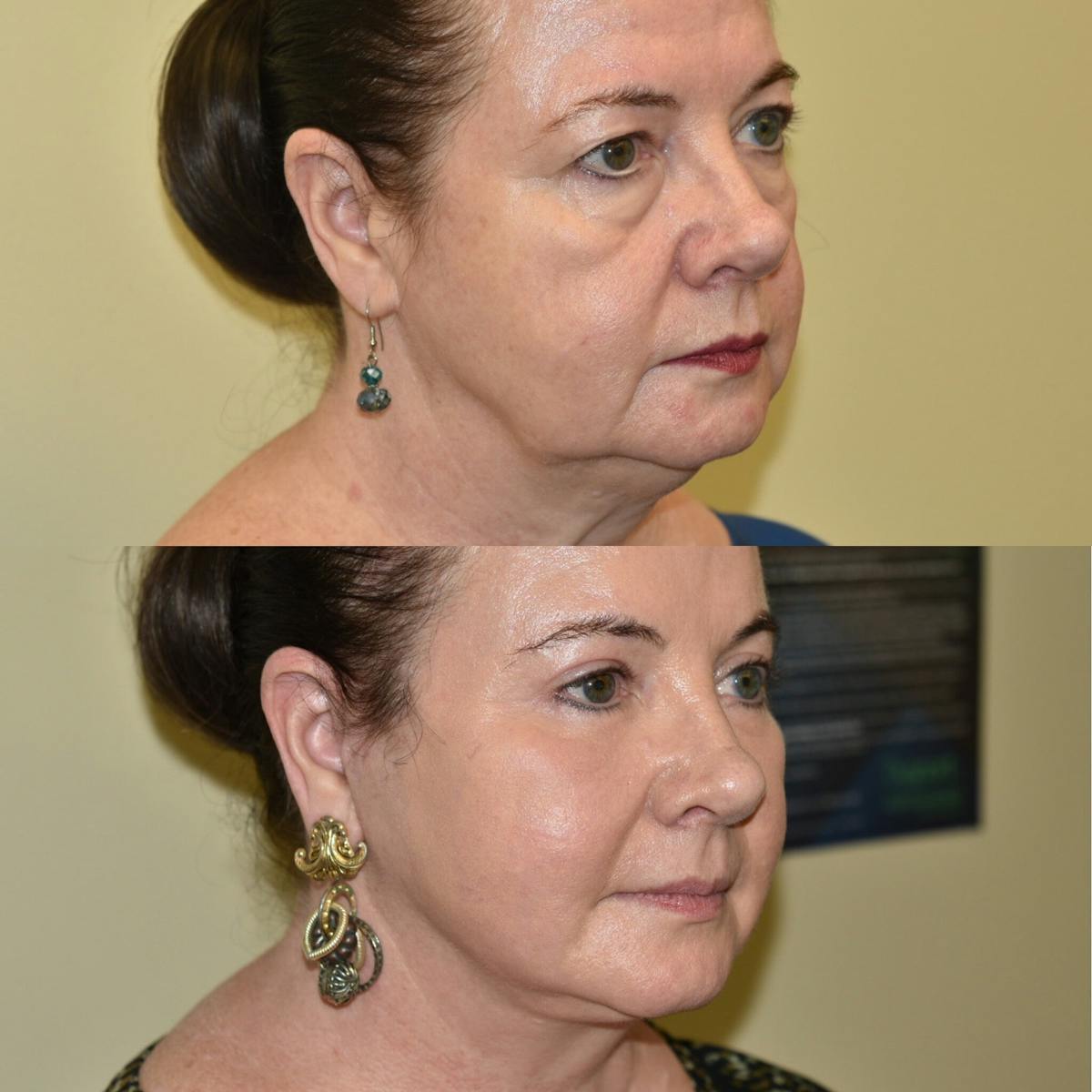 Eyelid Surgery Before & After Gallery - Patient 283826 - Image 3