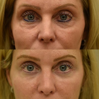 Fat Transfer Before & After Gallery - Patient 205147 - Image 1