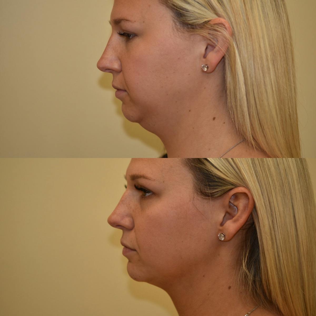 Face Liposuction Before & After Gallery - Patient 189026 - Image 1
