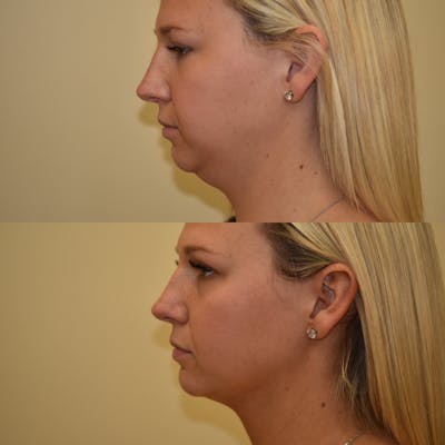 Chin Implant Before & After Gallery - Patient 252351 - Image 1