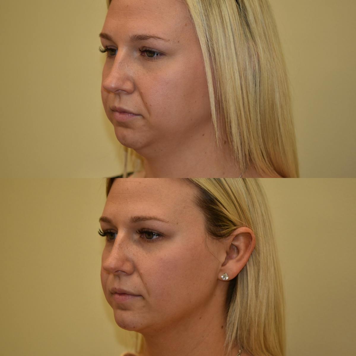 Face Liposuction Before & After Gallery - Patient 189026 - Image 2