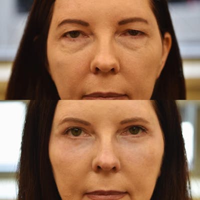 Eyelid Surgery Before & After Gallery - Patient 416625 - Image 1