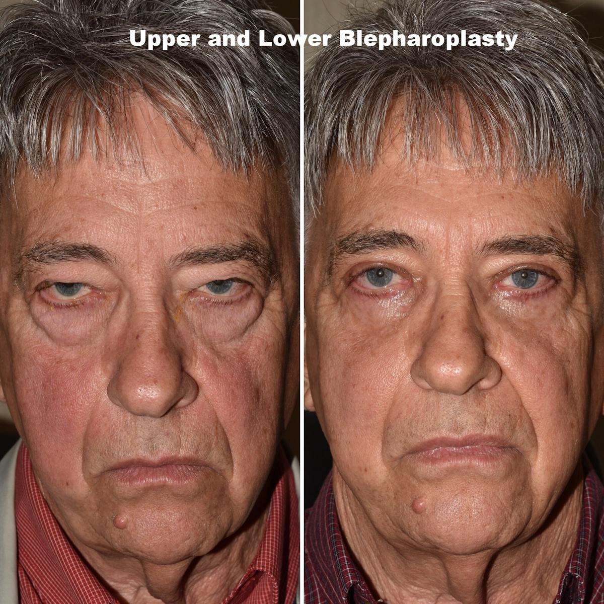 Eyelid Surgery Before & After Gallery - Patient 333504 - Image 1