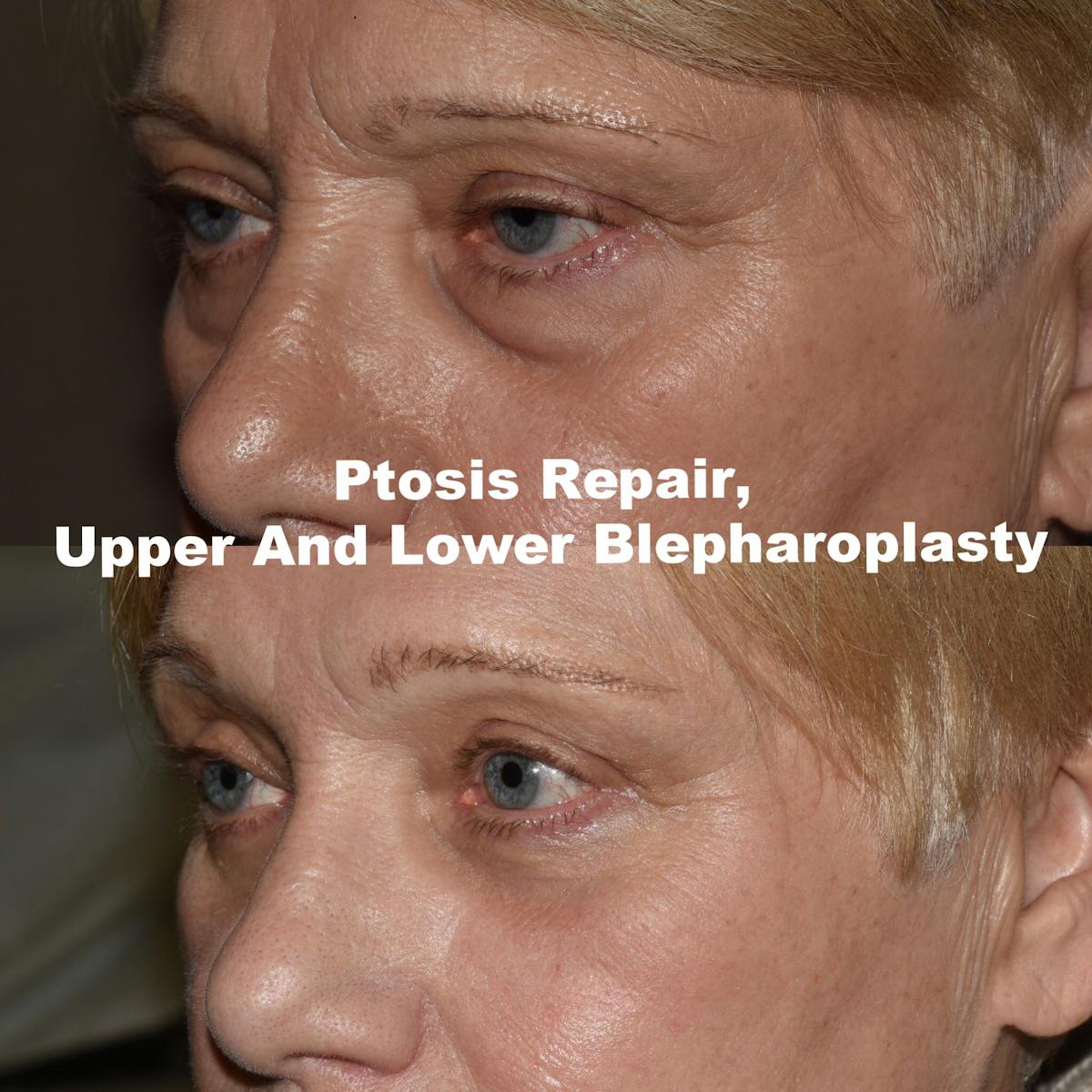 Eyelid Surgery Before & After Gallery - Patient 276061 - Image 1
