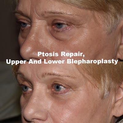 Eyelid Surgery Before & After Gallery - Patient 276061 - Image 1