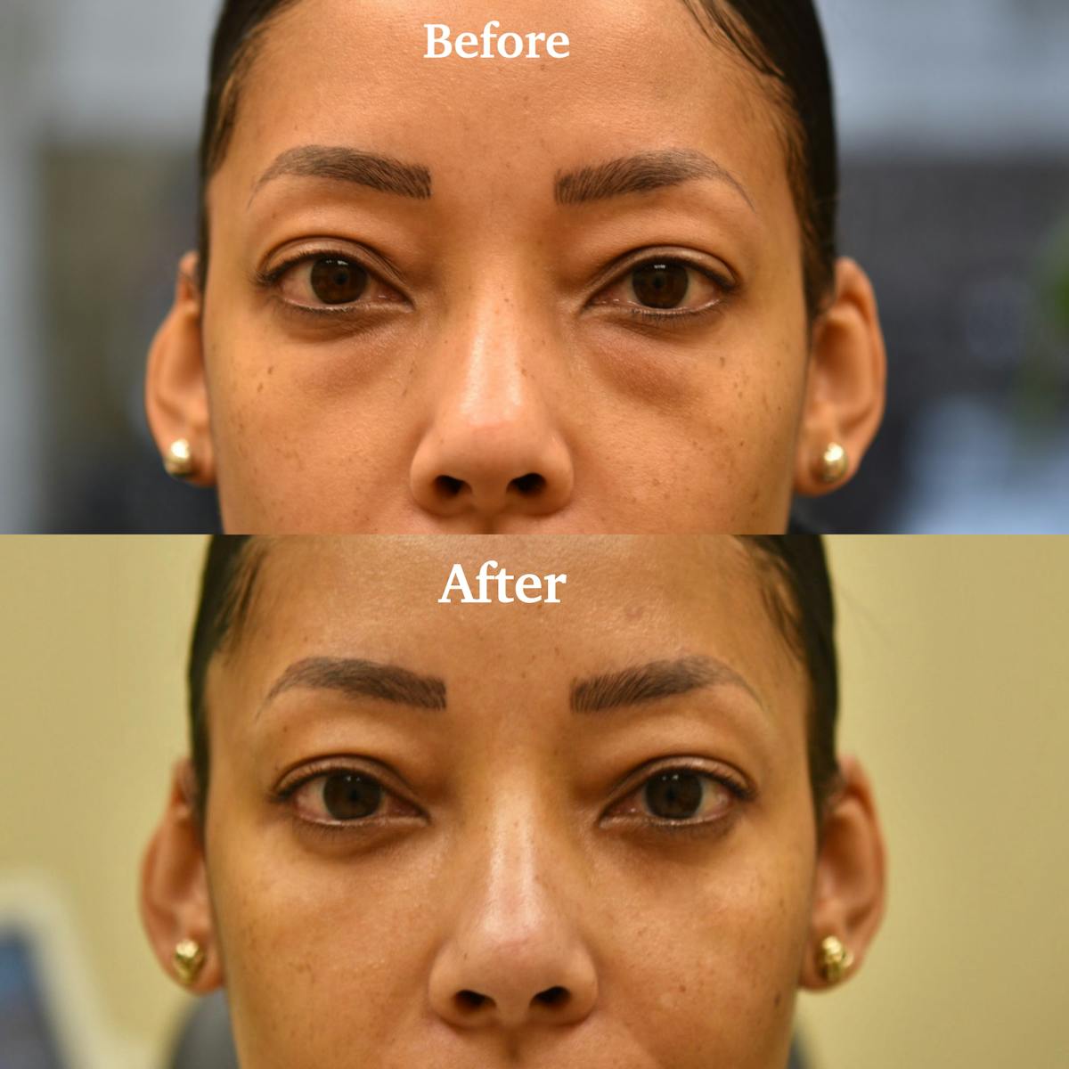 Fat Transfer Before & After Gallery - Patient 356823 - Image 1