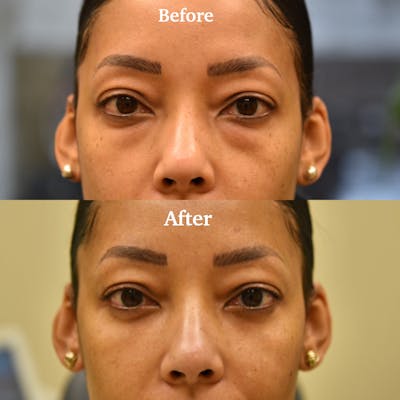 Fat Transfer Before & After Gallery - Patient 356823 - Image 1