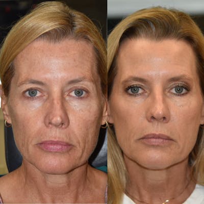 Facial Rejuvenation Before & After Gallery - Patient 345426 - Image 1