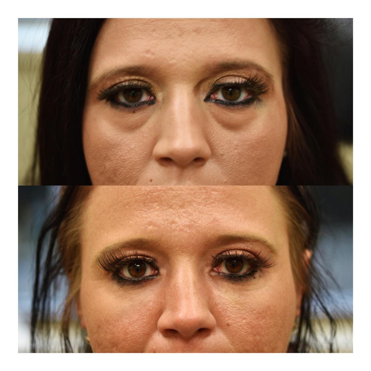 Fat Transfer Before & After Gallery - Patient 109253 - Image 1