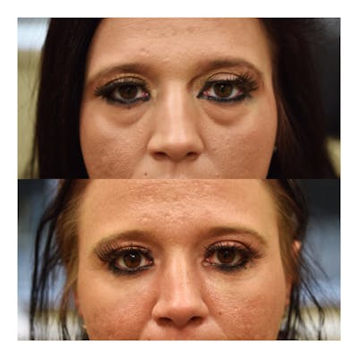Fat Transfer Before & After Gallery - Patient 109253 - Image 1