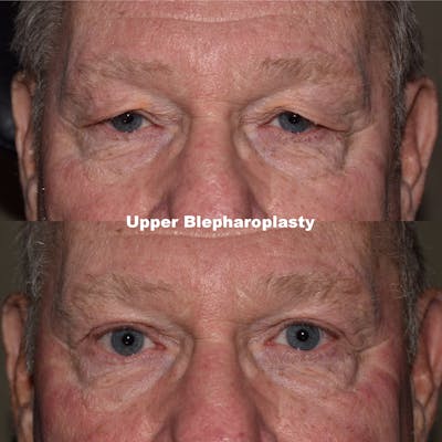 Eyelid Surgery Before & After Gallery - Patient 382941 - Image 1