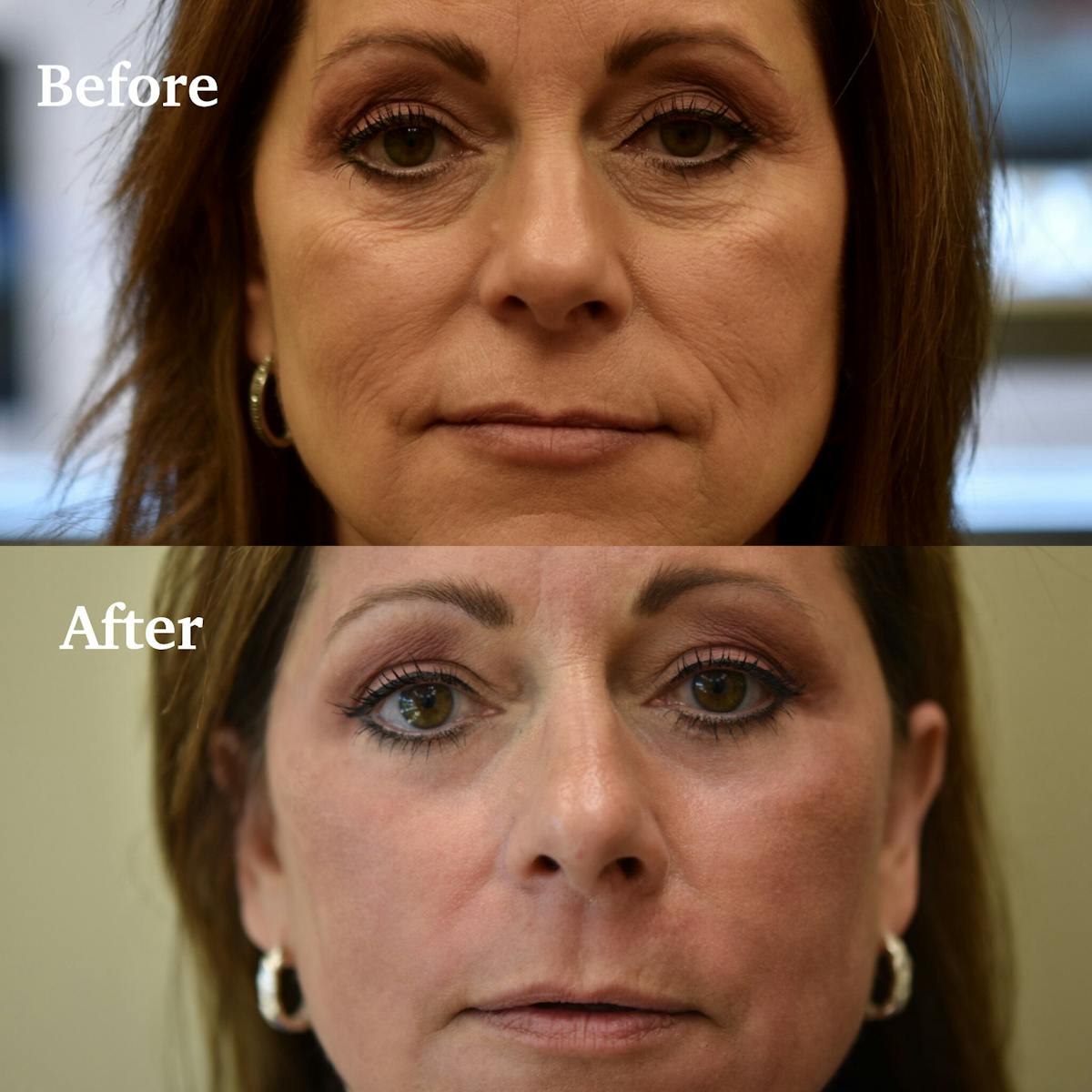 Laser Resurfacing Before & After Gallery - Patient 101430 - Image 1