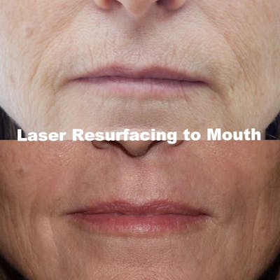 Laser Resurfacing Before & After Gallery - Patient 270563 - Image 1