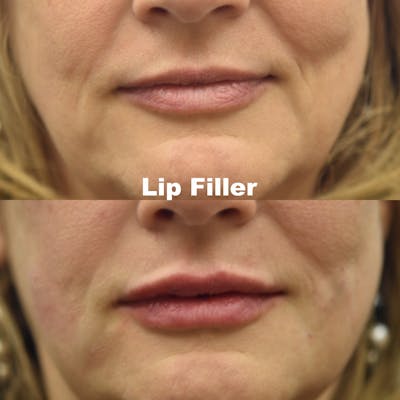 Lip Filler Before & After Gallery - Patient 767007 - Image 1