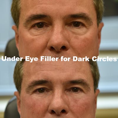 Under Eye Filler Before & After Gallery - Patient 600264 - Image 1