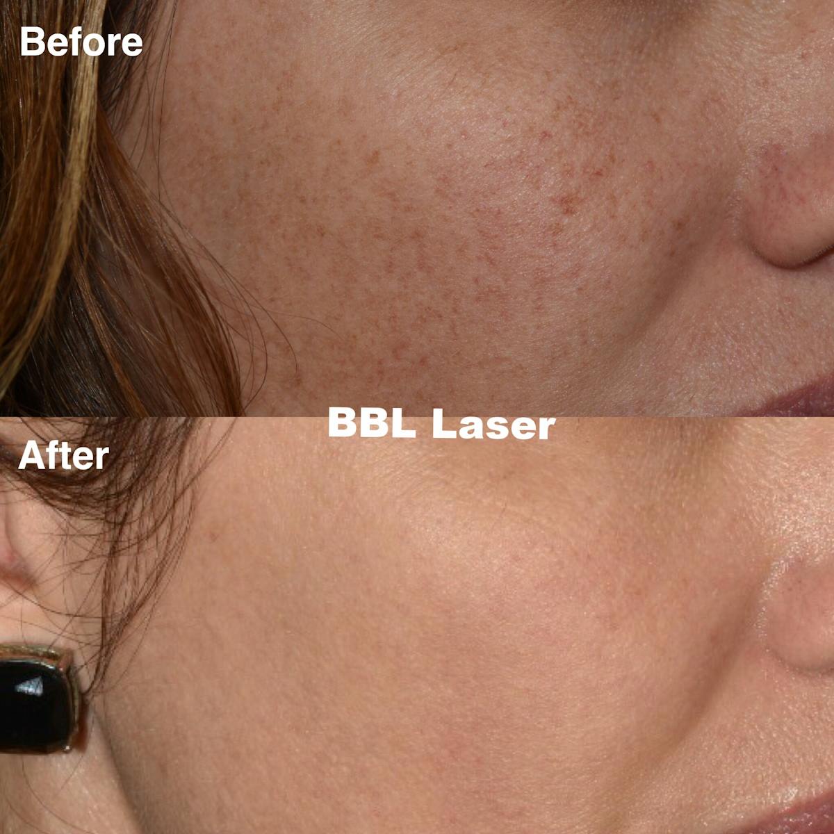 Laser Resurfacing Before & After Gallery - Patient 985587 - Image 1