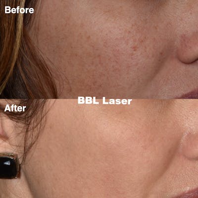 Laser Resurfacing Before & After Gallery - Patient 985587 - Image 1