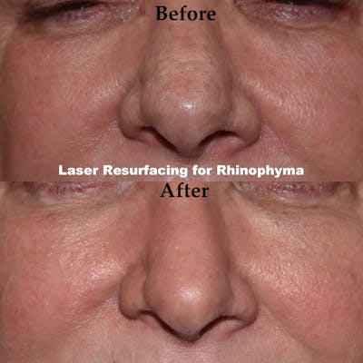 Laser Resurfacing Before & After Gallery - Patient 209625 - Image 1