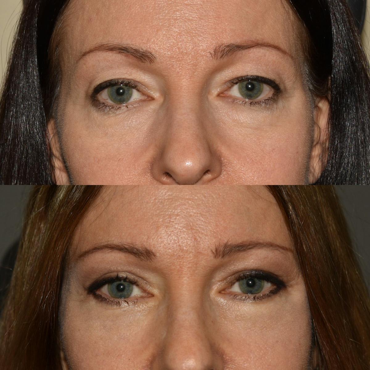 Eyelid Surgery Before & After Gallery - Patient 312864 - Image 1