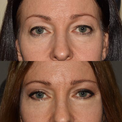 Eyelid Surgery Before & After Gallery - Patient 312864 - Image 1