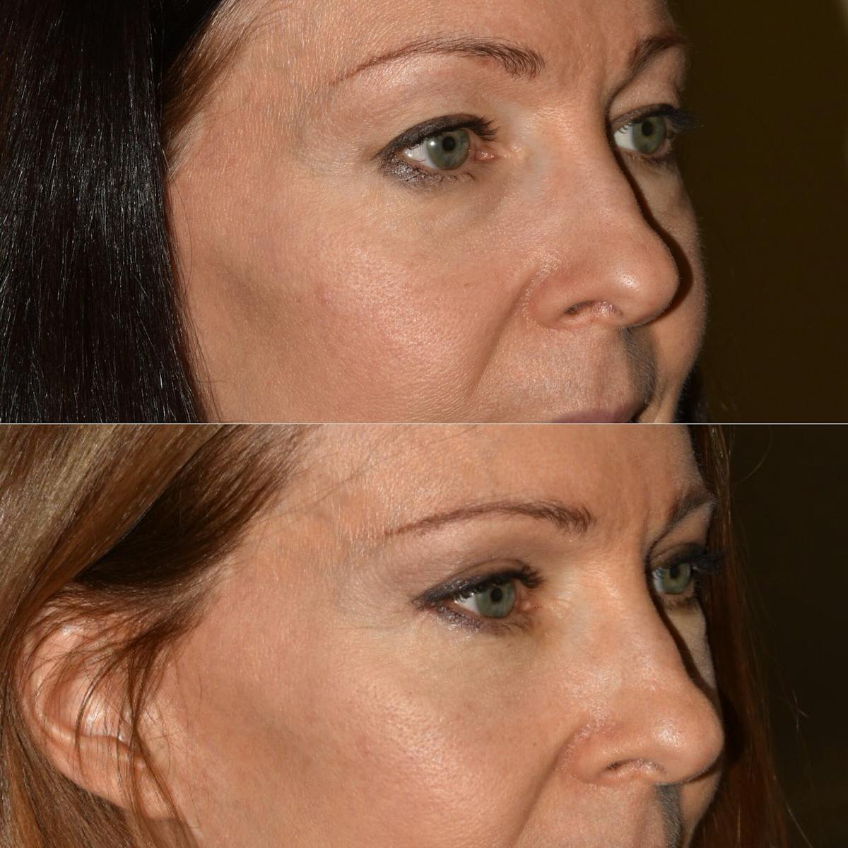 Eyelid Surgery Before & After Gallery - Patient 312864 - Image 2
