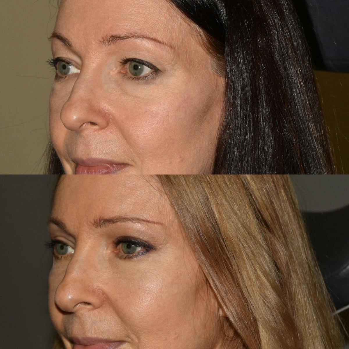 Eyelid Surgery Before & After Gallery - Patient 312864 - Image 3