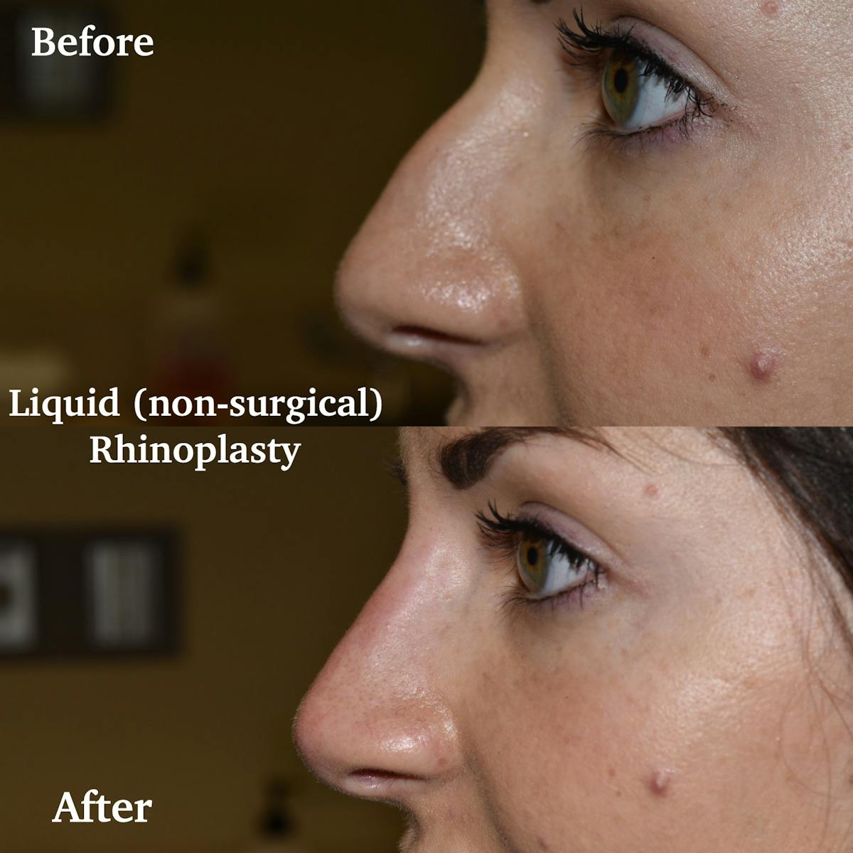 Liquid Rhinoplasty Before & After Gallery - Patient 307243 - Image 1