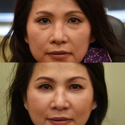 Fat Transfer Before & After Gallery - Patient 117841 - Image 1
