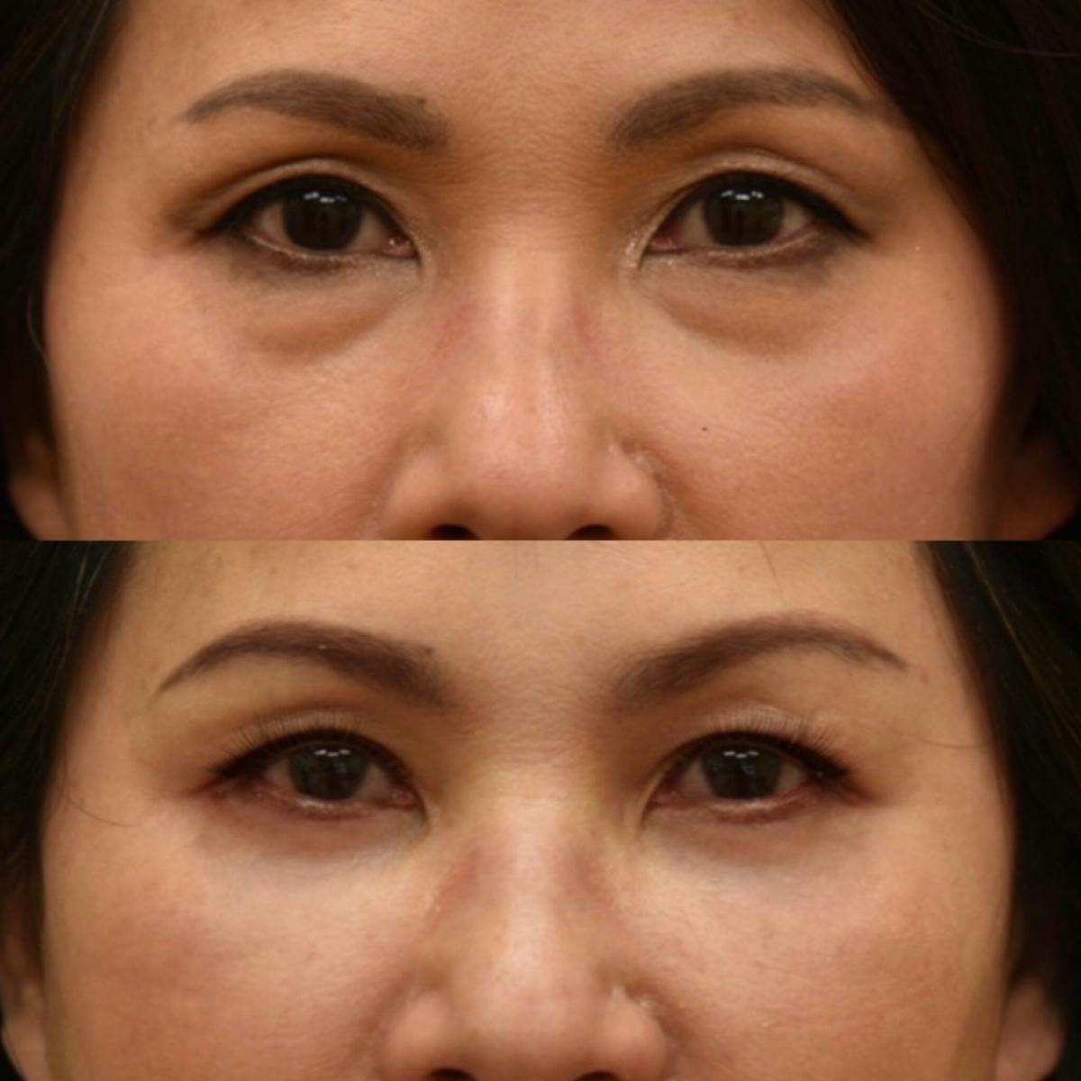 Fat Transfer Before & After Gallery - Patient 117841 - Image 2
