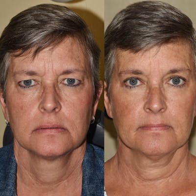Eyelid Surgery Before & After Gallery - Patient 364498 - Image 1