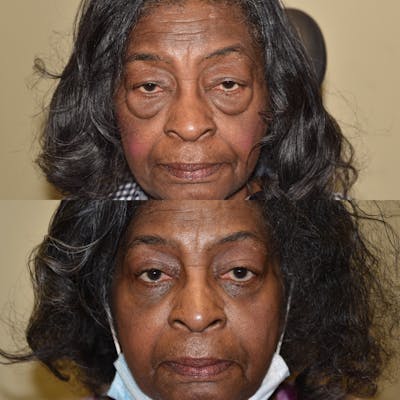 Eyelid Surgery Before & After Gallery - Patient 190267 - Image 1