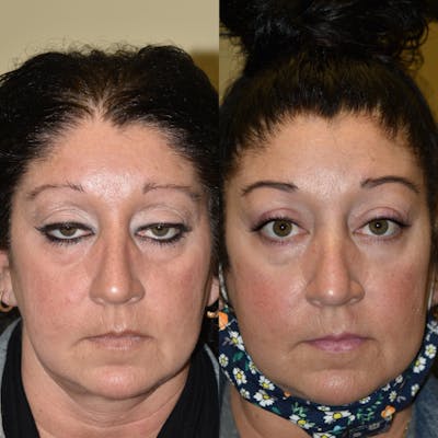 Eyelid Surgery Before & After Gallery - Patient 287947 - Image 1