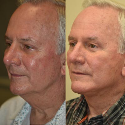 Neck Lift Before & After Gallery - Patient 278581 - Image 1