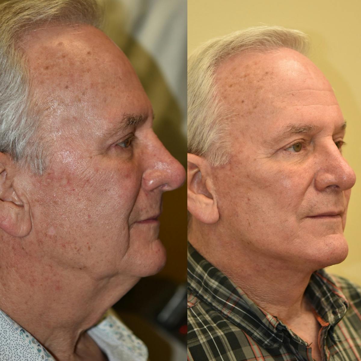 Neck Lift Before & After Gallery - Patient 278581 - Image 2