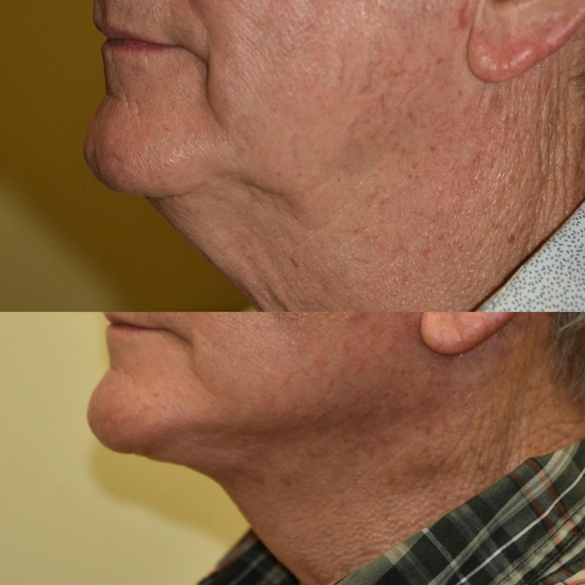 Neck Lift Before & After Gallery - Patient 278581 - Image 3