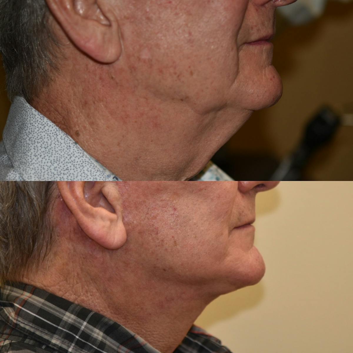 Neck Lift Before & After Gallery - Patient 278581 - Image 4