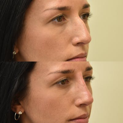 Eyelid Surgery Before & After Gallery - Patient 425351 - Image 1