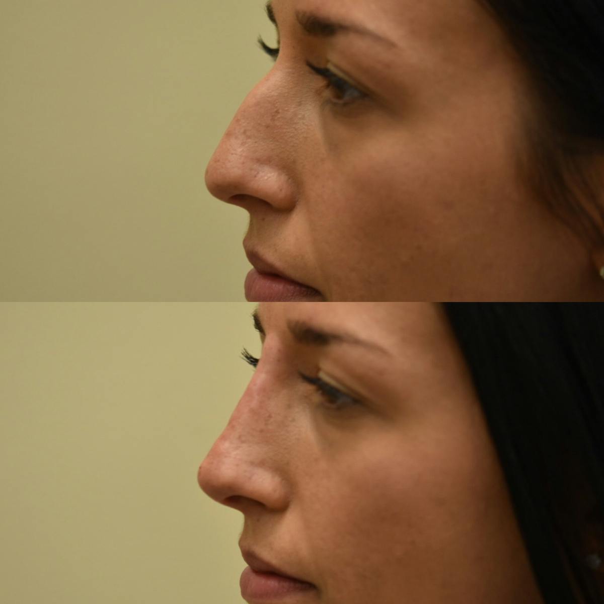 Eyelid Surgery Before & After Gallery - Patient 425351 - Image 2