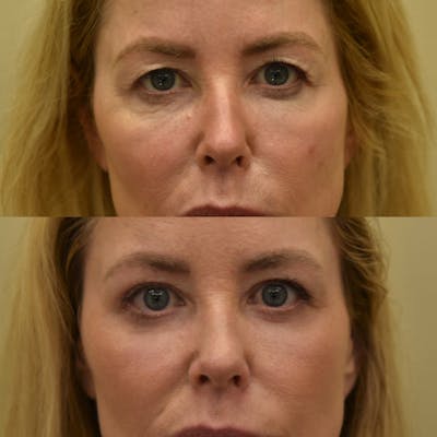Eyelid Surgery Before & After Gallery - Patient 174418 - Image 1