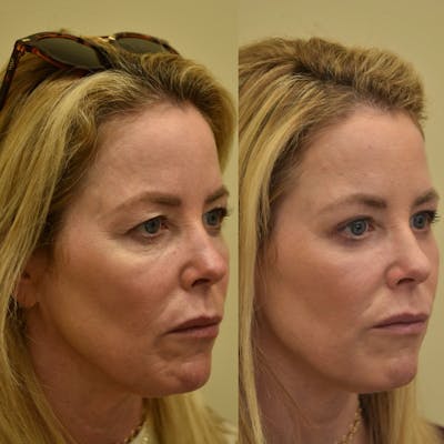 Laser Resurfacing Before & After Gallery - Patient 160648 - Image 1