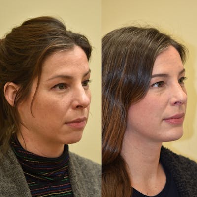 Chin Implant Before & After Gallery - Patient 187362 - Image 1