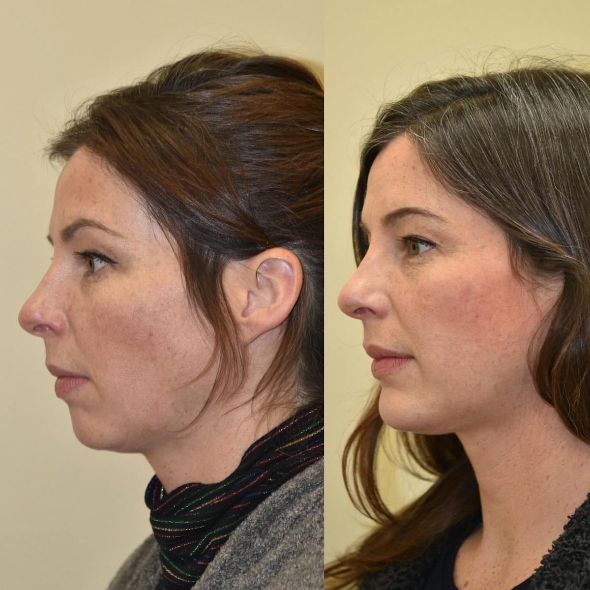 Chin Implant Before & After Gallery - Patient 187362 - Image 2